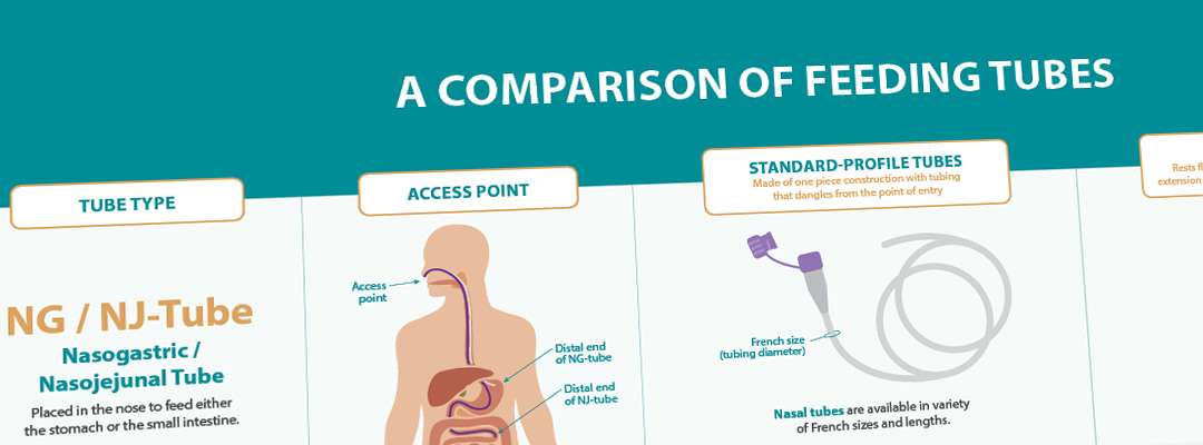 Comparison of Different Enteral Feeding Tubes and Configurations