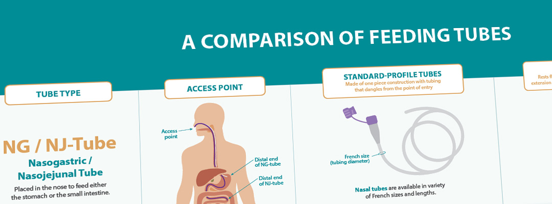 Enteral Feeding Tubes and Devices